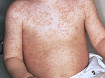 measles_torso_medimg_pho_en